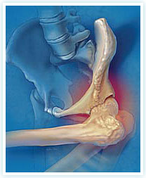 koksartroza kučnog zgloba 3 stupnja jaka bol